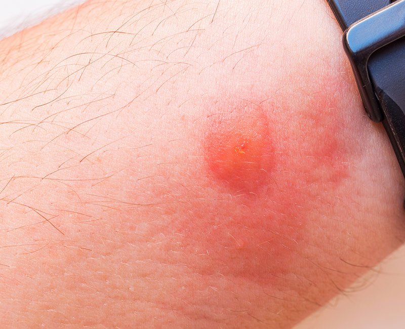 You put this on Horsefly Bites spray bottle